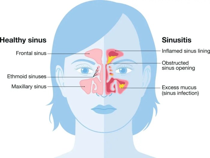 Michael has an infection in his sinuses