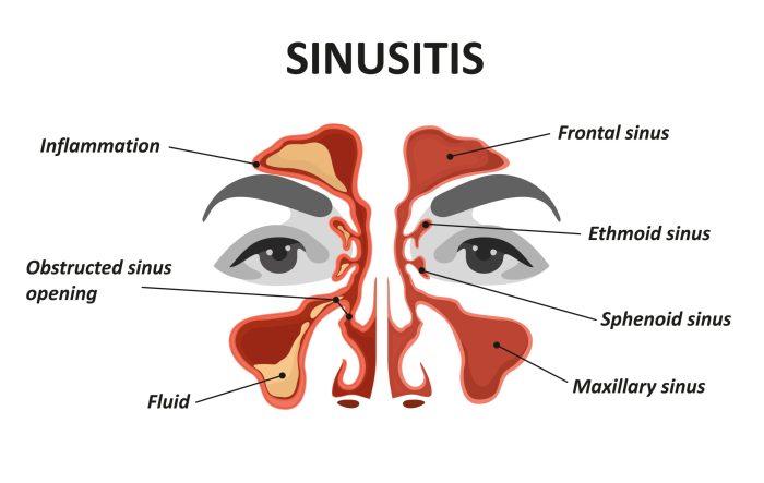 Sinus infection helped endonasal adjusting infections cranial